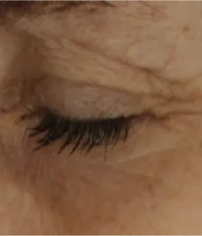 Eyes day 0