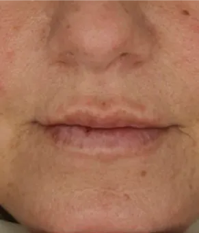 Lips day 0